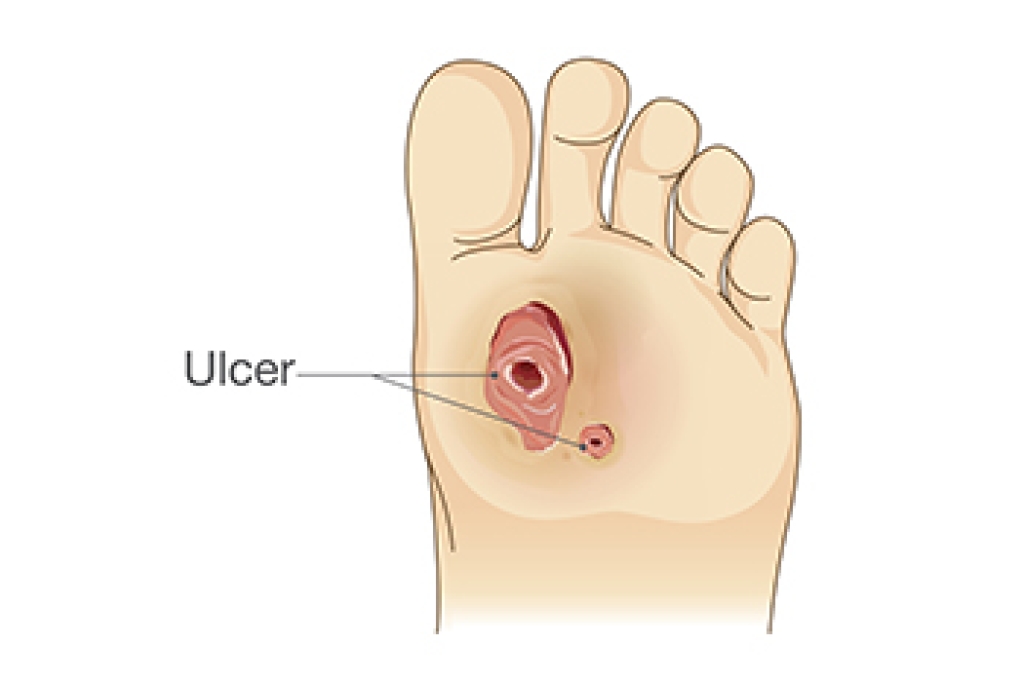 Foot Ulcers and Diabetes