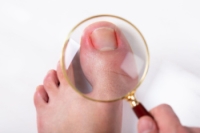 What to Know About Treating Ingrown Toenails