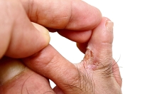 Athlete’s Foot Causes and Symptoms