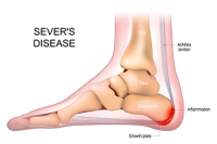 Facts About Sever’s Disease