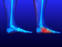 Can Flat Feet Cause Pain?