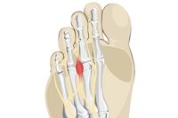 Causes and Signs of Morton’s Neuroma