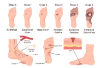 Debridement Methods for Diabetic Foot Ulcers