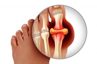 Foods and Gout