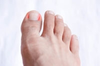 Managing an Ingrown Toenail