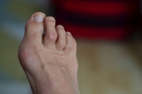 Complications of Untreated Hammertoes