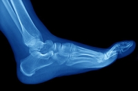 Elevation May Bring Relief to Stress Fractures in the Feet