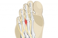 Who Is Susceptible to Morton’s Neuroma?
