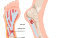 Plantar Fasciitis Is a Common Foot Problem