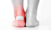 How to Prevent Foot Blisters